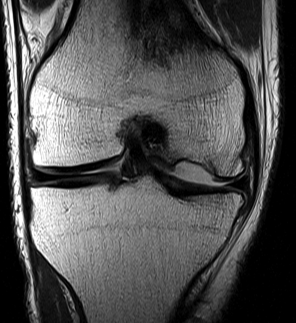 Knee OCD MRI Displaced and Empty Crater